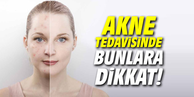 Akne tedavisinde bunlara dikkat!
