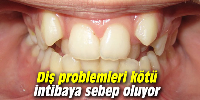 Diş problemleri kötü intibaya sebep oluyor