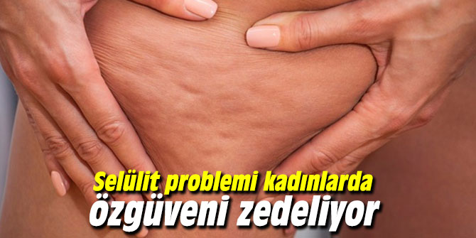 Selülit problemi kadınlarda özgüveni zedeliyor