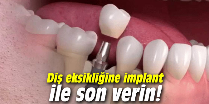 Diş eksikliğine implant ile son verin!