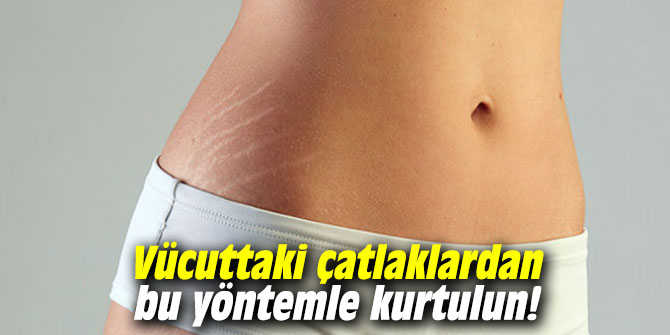 Vücuttaki çatlaklardan bu yöntemle kurtulun!
