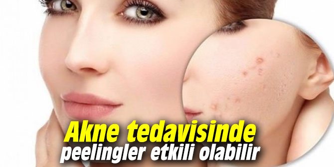 Akne tedavisinde peelingler etkili olabilir