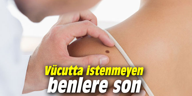 Vücutta istenmeyen benlere son