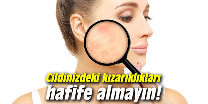 Cildinizdeki kızarıklıkları hafife almayın!