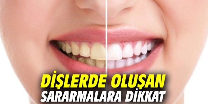 Dişlerde oluşan sararmalara dikkat
