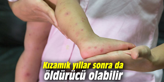 Kızamık yıllar sonra da öldürücü olabilir