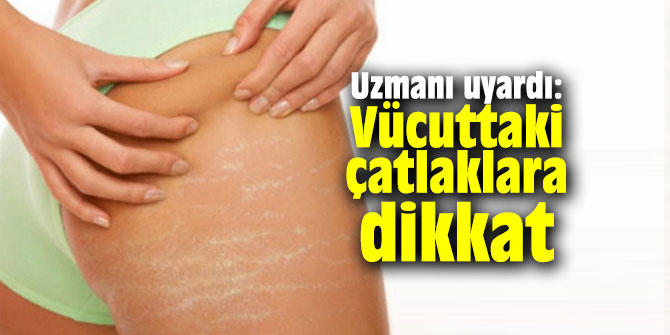 Uzmanı uyardı: Vücutta oluşan çatlamalara dikkat