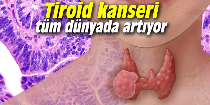 Tiroid kanseri tüm dünyada artıyor