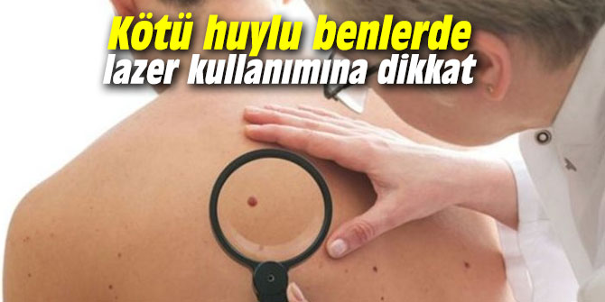 Kötü huylu benlerde lazer kullanımına dikkat