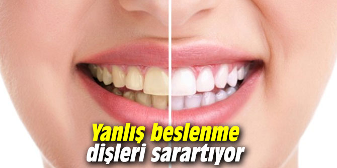 Yanlış beslenme dişleri sarartıyor