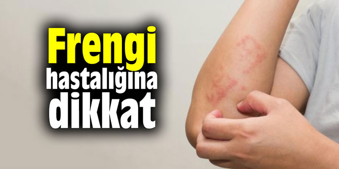 Frengi hastalığına dikkat