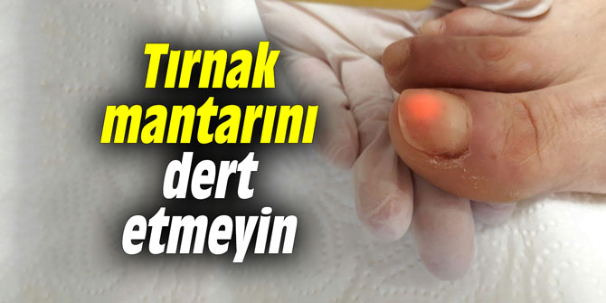 Tırnak mantarını dert etmeyin