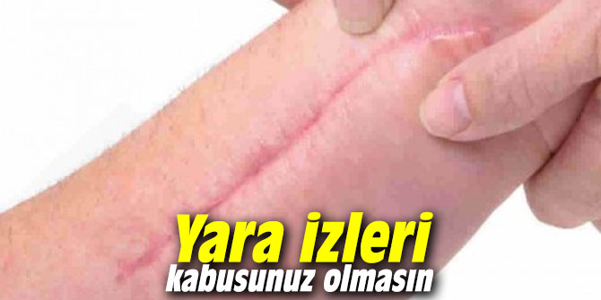 Yara izleri kabusunuz olmasın