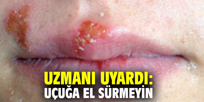 Uzmanı uyardı: Uçuğa el sürmeyin