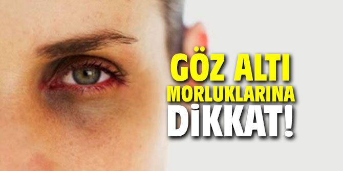 Göz altı morluklarına dikkat!
