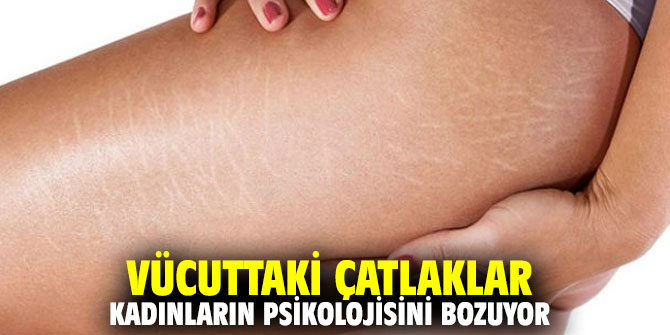 Vücuttaki çatlaklar kadınların psikolojisini bozuyor
