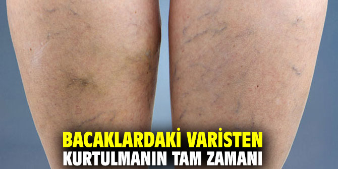 Bacaklardaki varisten kurtulmanın tam zamanı