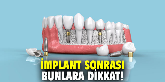 Uzmanı açıkladı! İmplant sonrası bunlara dikkat