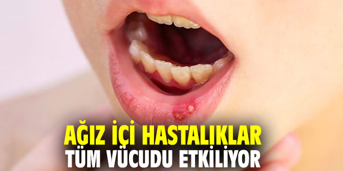 Ağız içi hastalıklar tüm vücudu etkiliyor