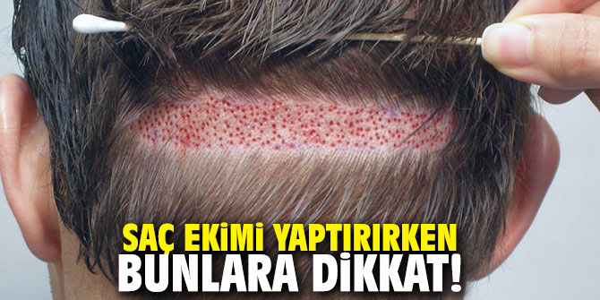 Saç ekimi yaptırırken bunlara dikkat!