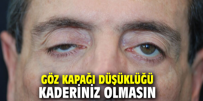 Göz kapağı düşüklüğü kaderiniz olmasın