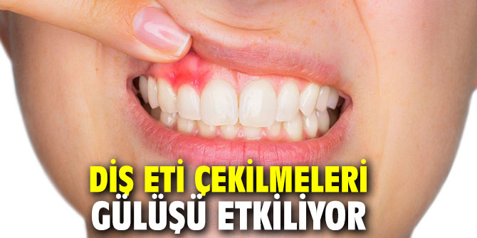 Diş eti çekilmeleri gülüşü etkiliyor