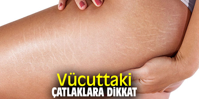 Vücuttaki çatlaklara dikkat