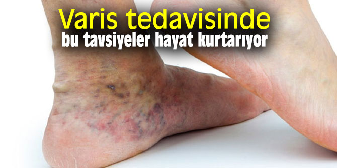 Varis tedavisinde bu tavsiyeler hayat kurtarıyor