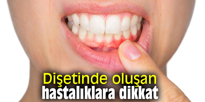 Dişetinde oluşan hastalıklara dikkat