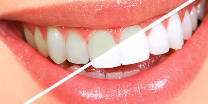 Sağlıklı gülüş Dental estetikten