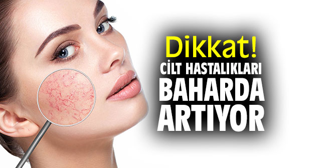 Dikkat! Cilt hastalıkları baharda artıyor