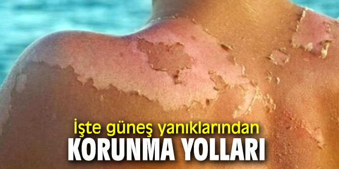 İşte güneş yanıklarından korunma yolları