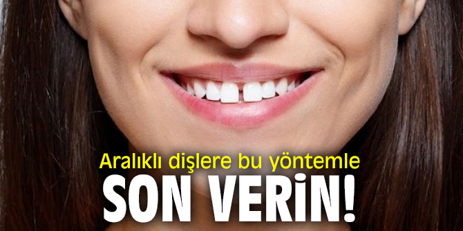 Aralıklı dişlere bu yöntemle son verin!