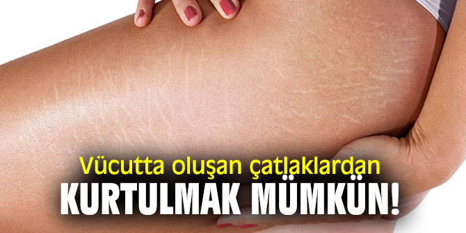 Vücutta oluşan çatlaklardan kurtulmak mümkün!