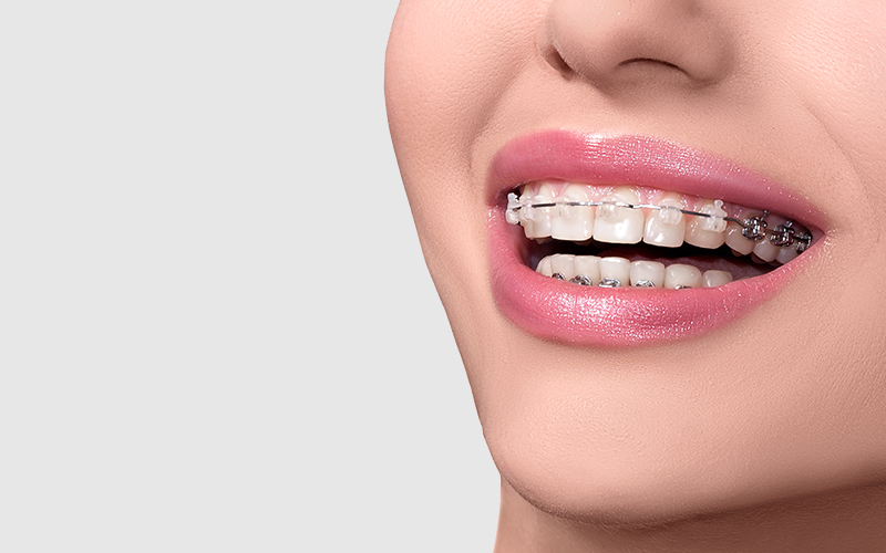 Diş Teli Tedavisi Adımları