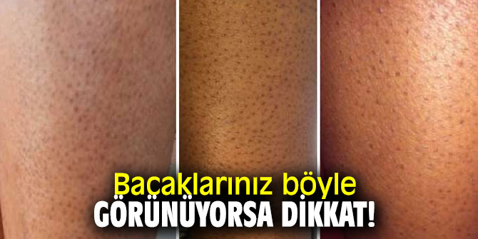 Aman dikkat! Bacaklarınız böyle görünüyorsa...