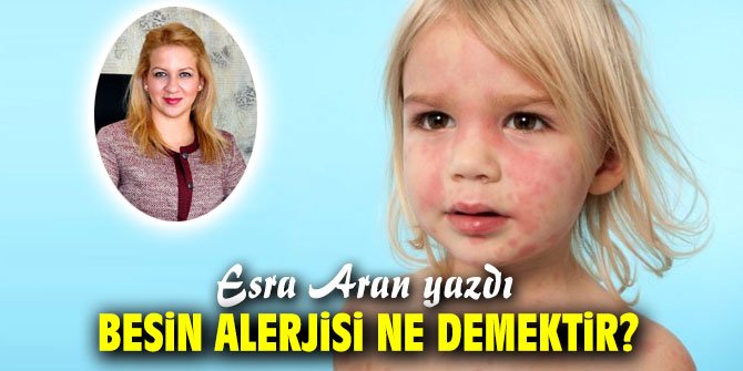 Besin alerjisi ne demektir? 