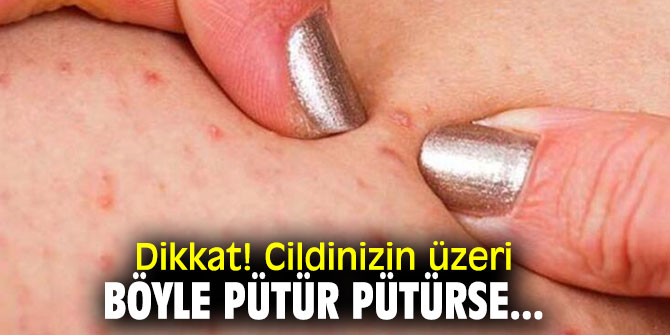 Dikkat! Cildinizin üzeri böyle pütür pütürse...