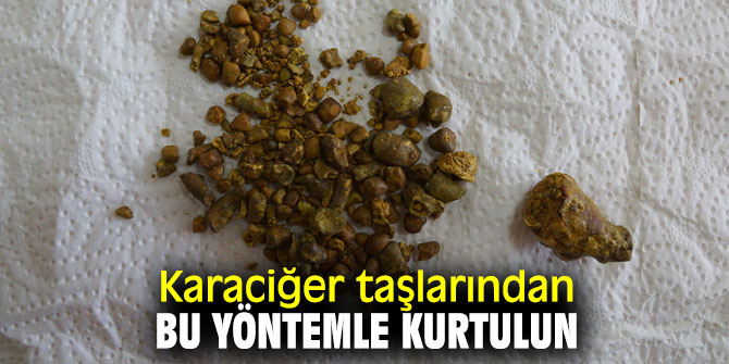 Uzmanı açıkladı! Karaciğer taşlarından bu yöntemle kurtulun