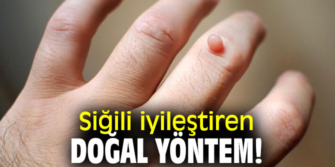 Siğili iyileştiren doğal yöntem!