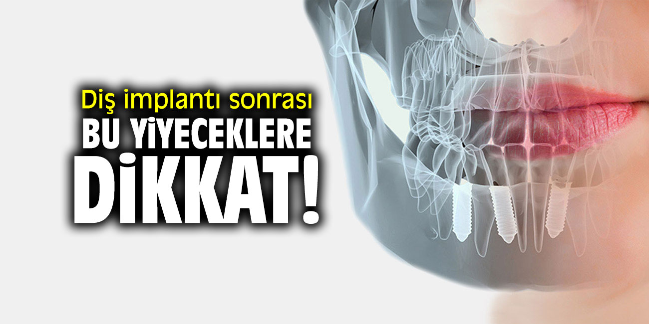 Diş implantı sonrası bunlara dikkat!