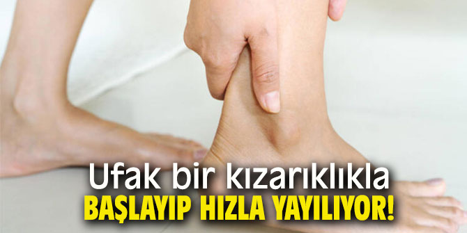 Ufak bir kızarıklıkla başlayıp hızla yayılıyor!