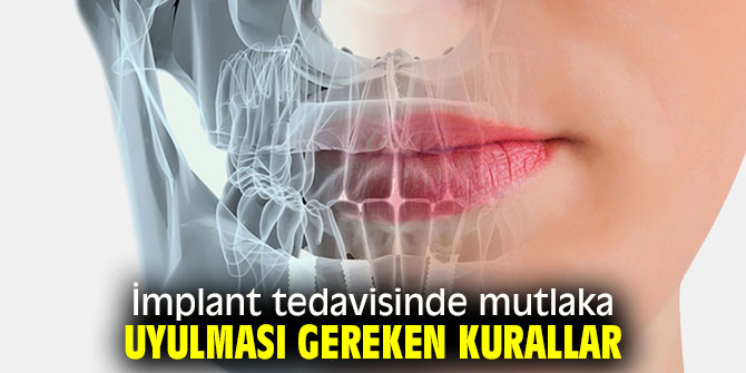 İmplant tedavisinde kurallara mutlaka uyulmalı!