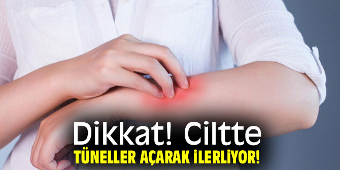 Dikkat! Ciltte tüneller açarak ilerliyor!