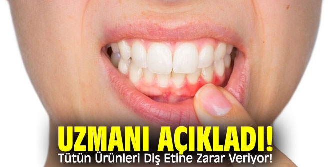 Uzmanı açıkladı! Tütün Ürünleri Diş Etine Zarar Veriyor!