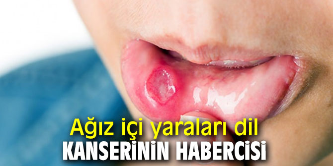 Ağız içi yaraları dil kanserinin habercisi olabilir!