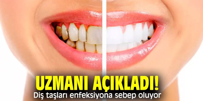 Uzmanı açıkladı! Diş taşları enfeksiyona sebep oluyor