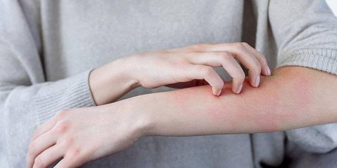 İzmir'de artan uyuz vakaları hakkında açıklama!