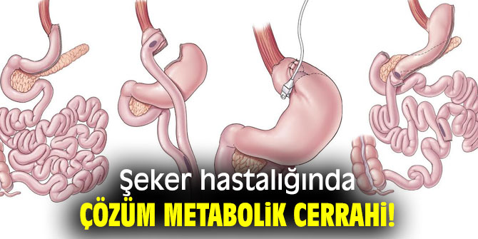 Şeker hastalığında çözüm metabolik cerrahi!