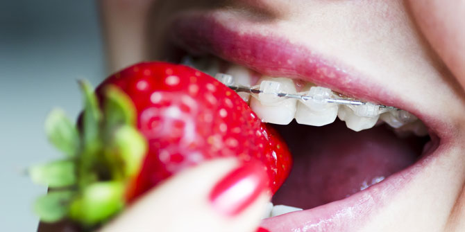 Diş teli hakkında doğru bilinen yanlışlar!